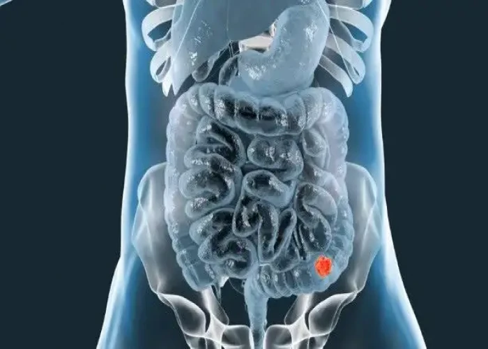 Small bowel cancer