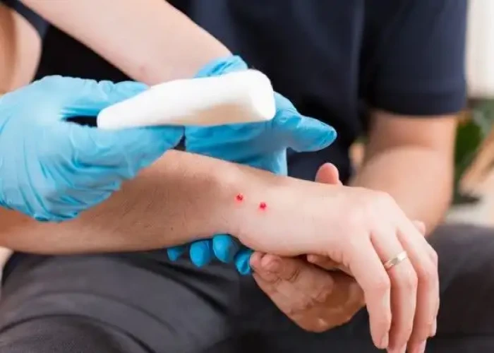 Snake bite