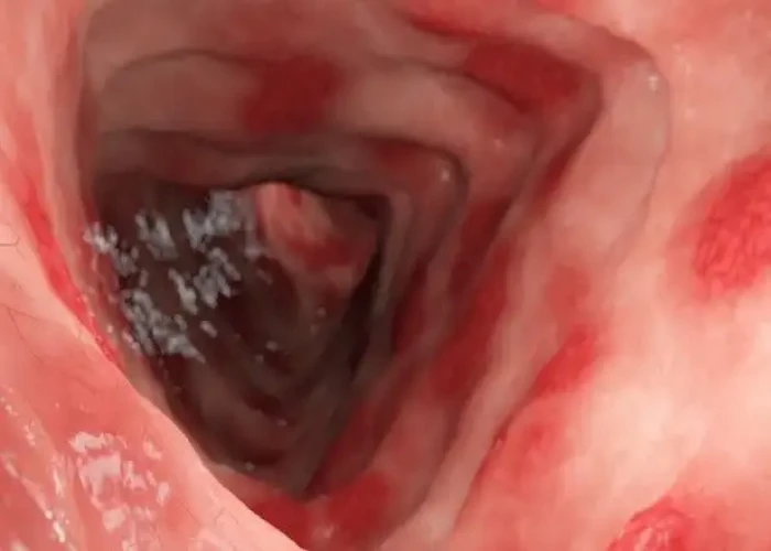 Solitary rectal ulcer syndrome