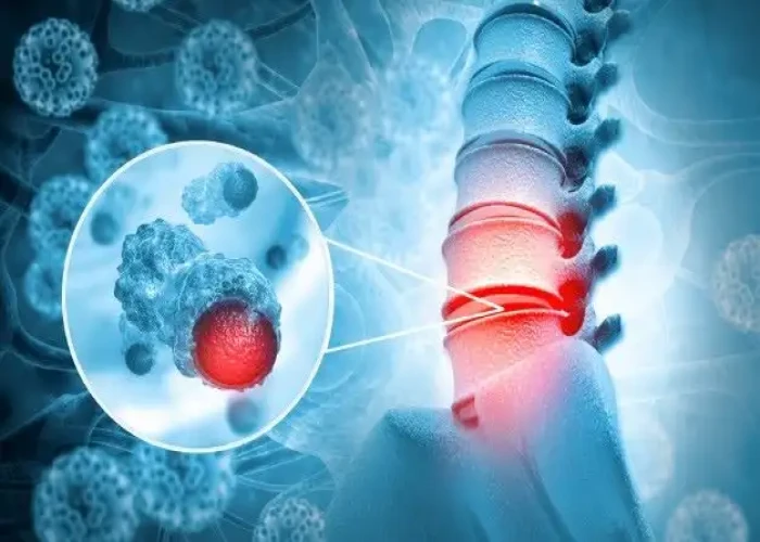 Spinal cord tumor
