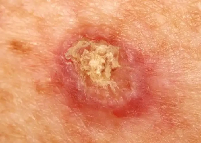 Squamous cell carcinoma of the skin
