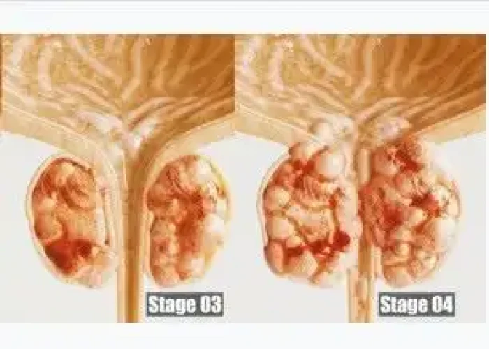 Stage 4 prostate cancer