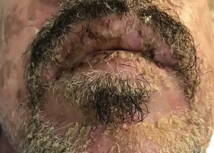 Stevens-Johnson syndrome