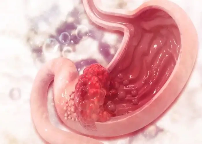 Stomach cancer