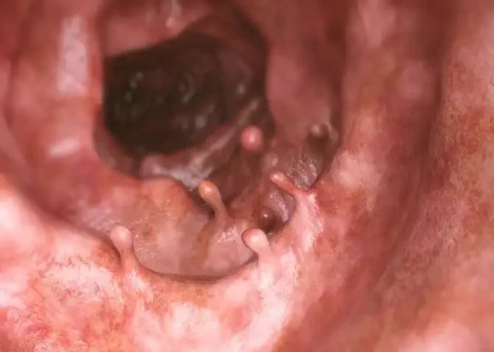 Stomach polyps
