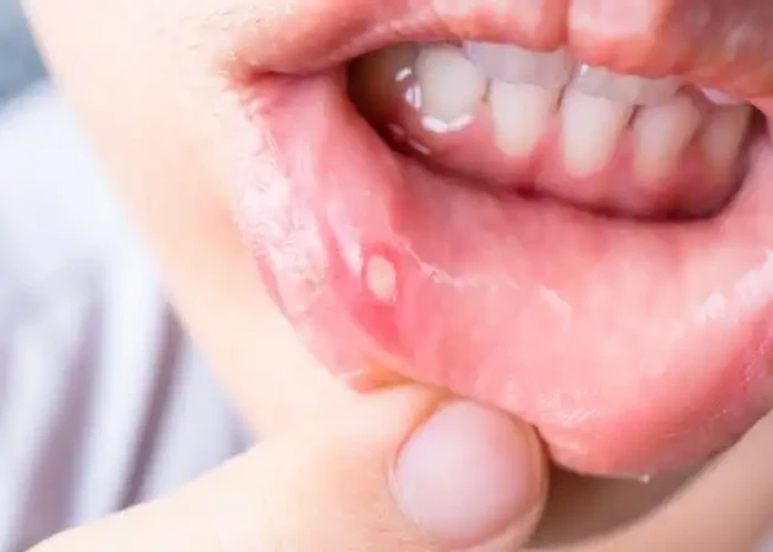 Stomatitis