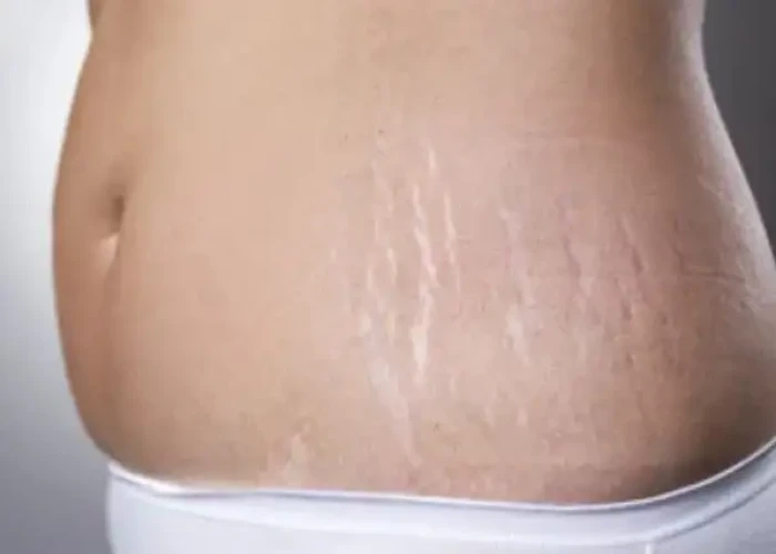 Stretch marks