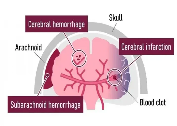 Subarachnoid hemorrhage