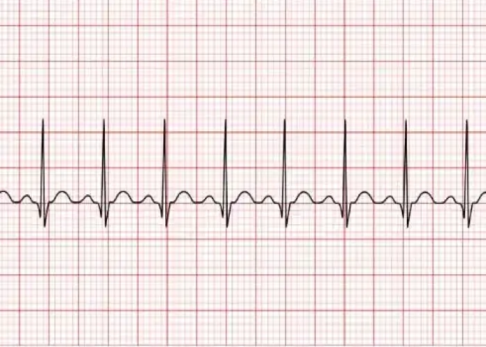 Tachycardia
