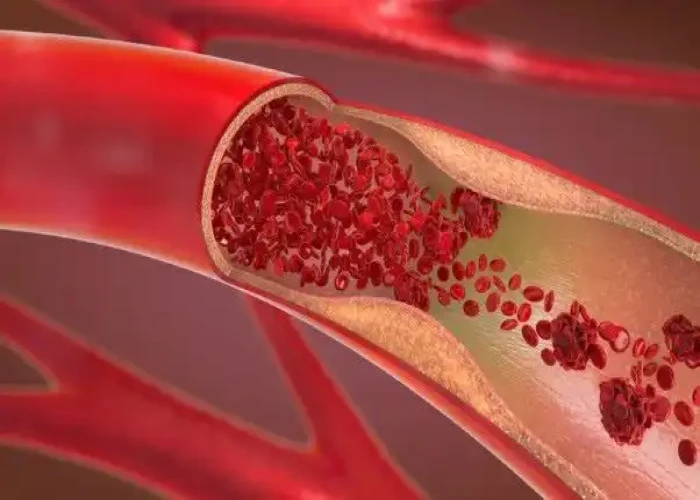 Takayasu's arteritis