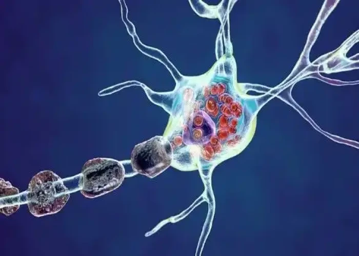 Tay-Sachs disease