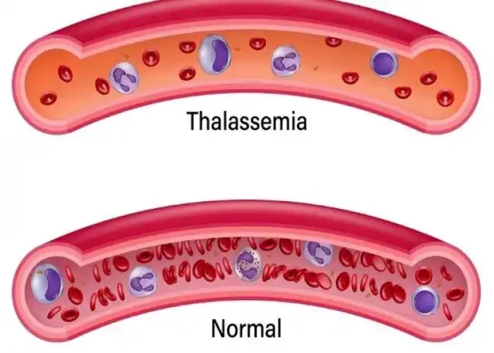 Thalassemia