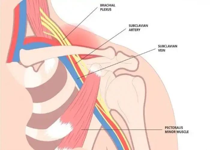 Thoracic outlet syndrome