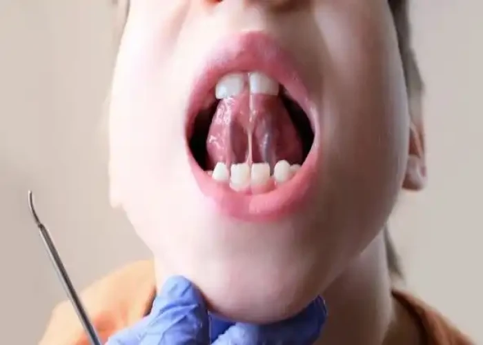 Tongue-tie (ankyloglossia)