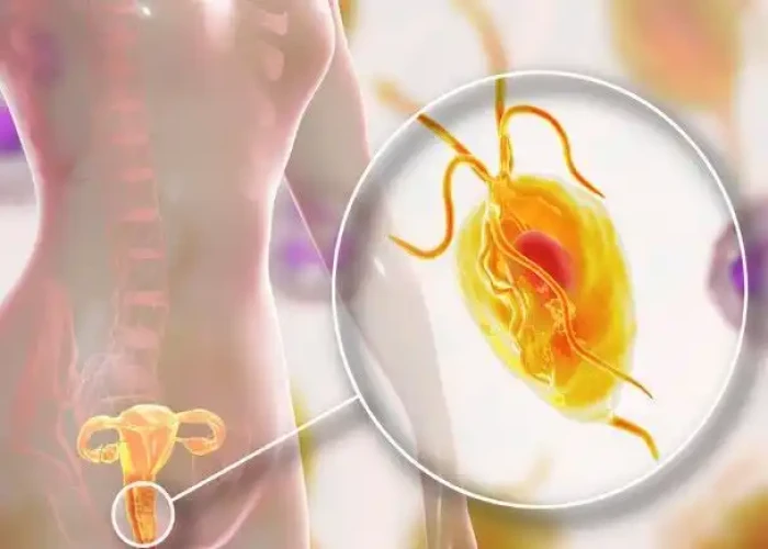 Trichomoniasis