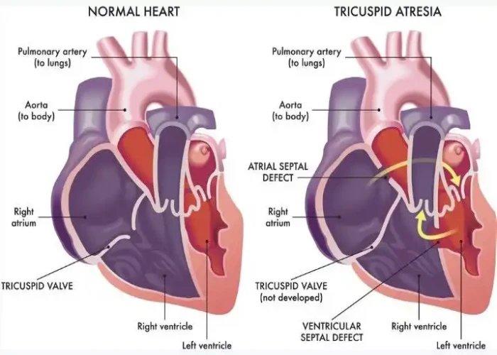 Tricuspid atresia