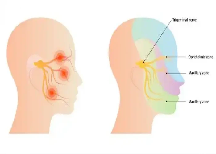 Trigeminal neuralgia