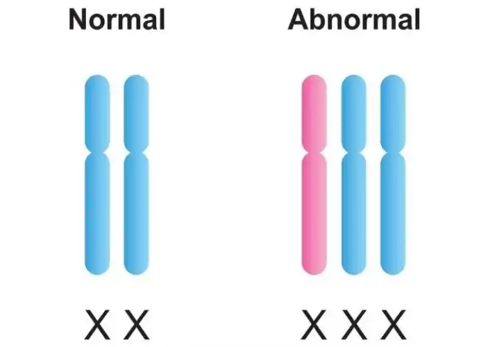 Triple X syndrome