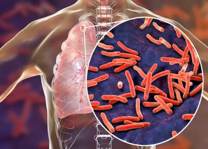 Tuberculosis