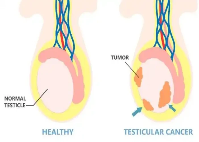 Undescended testicle