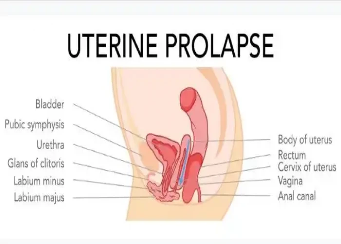 Uterine prolapse