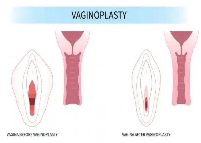Vaginal agenesis