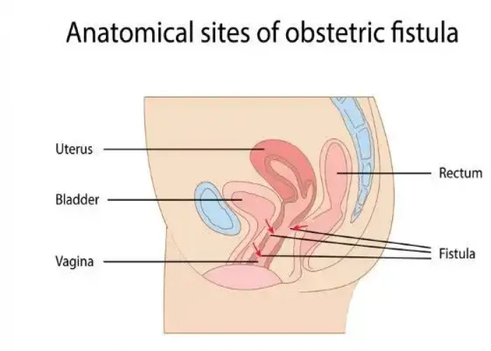 Vaginal fistula