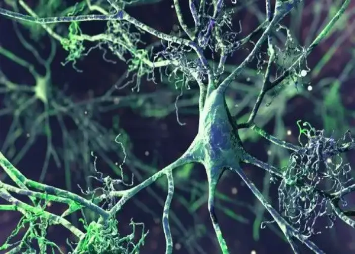 Vascular dementia