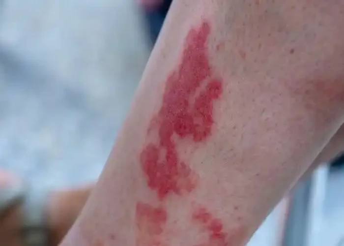 Vasculitis