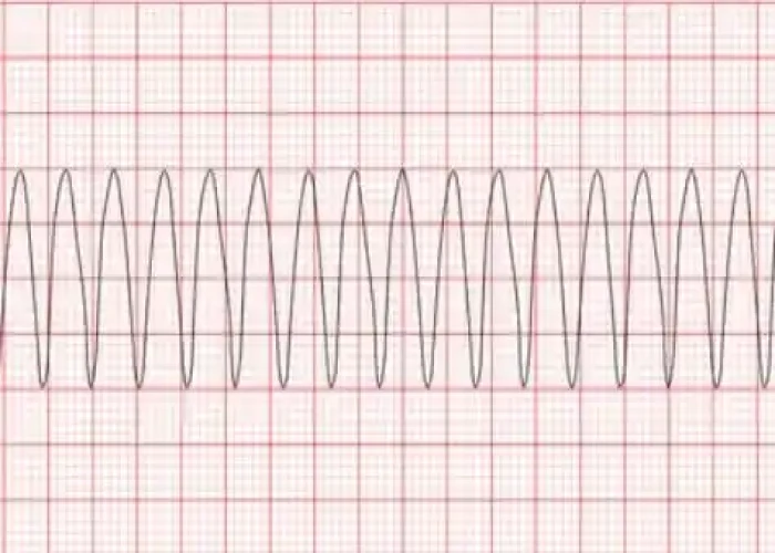 Ventricular tachycardia
