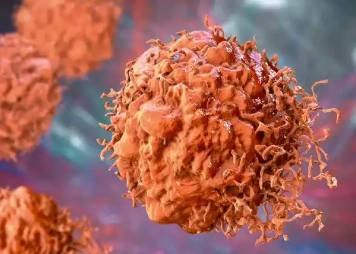 Wilms' tumor