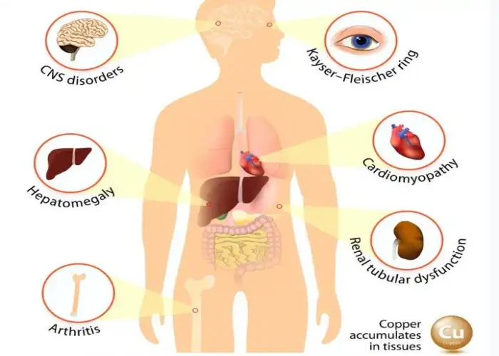 Wilson's disease