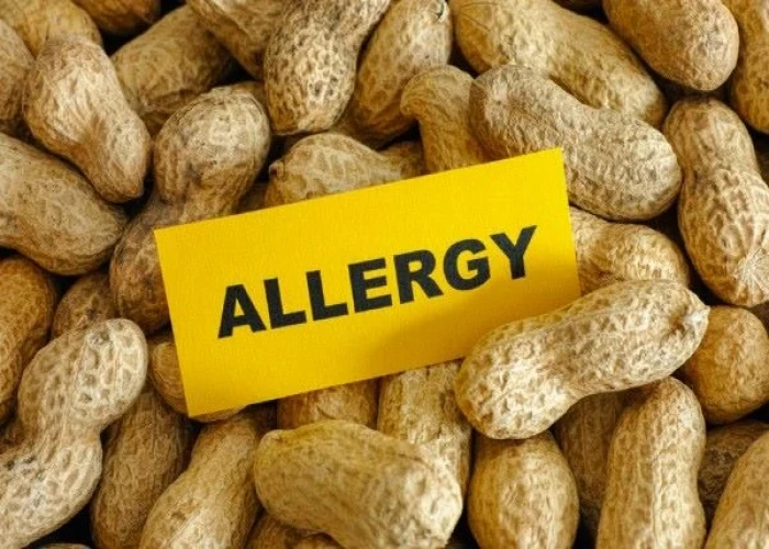 Peanut allergy