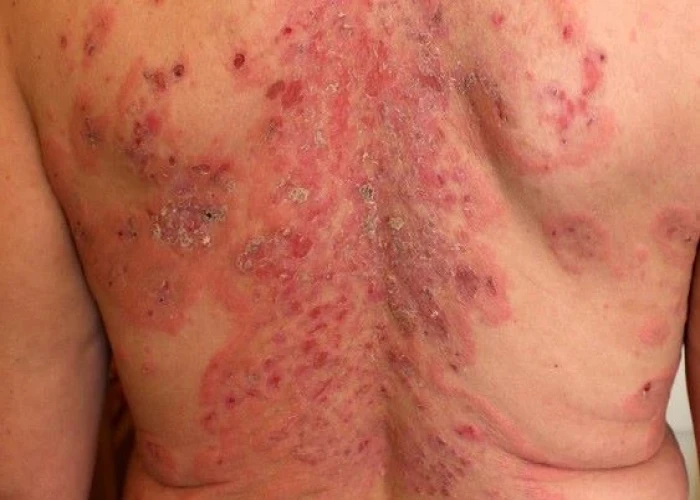 Pemphigus