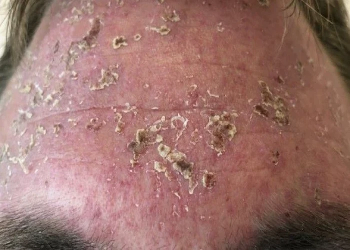 Penicillin allergy