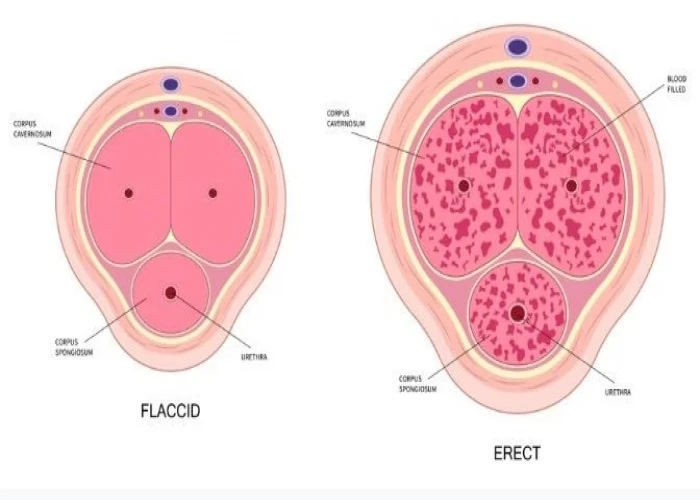 Peyronie's disease