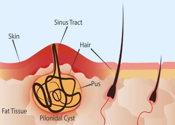 Pilonidal cyst
