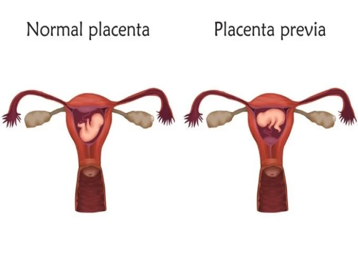 Placenta previa