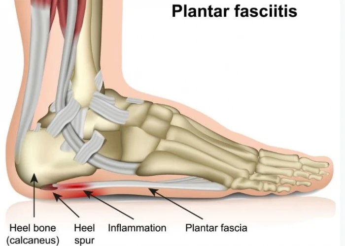 Plantar fasciitis