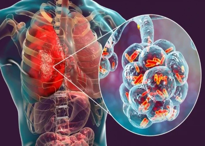 Pneumonia