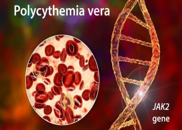 Polycythemia vera