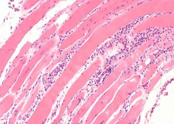 Polymyositis