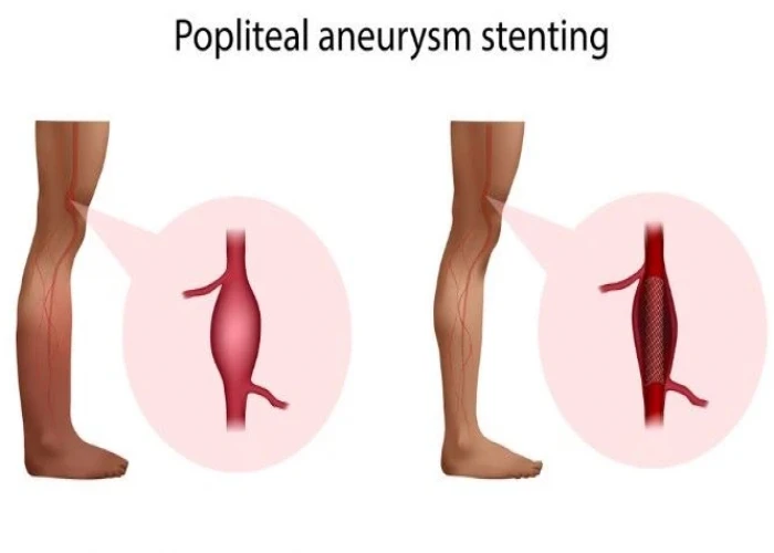 Popliteal artery aneurysm