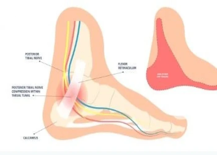 Popliteal artery entrapment syndrome