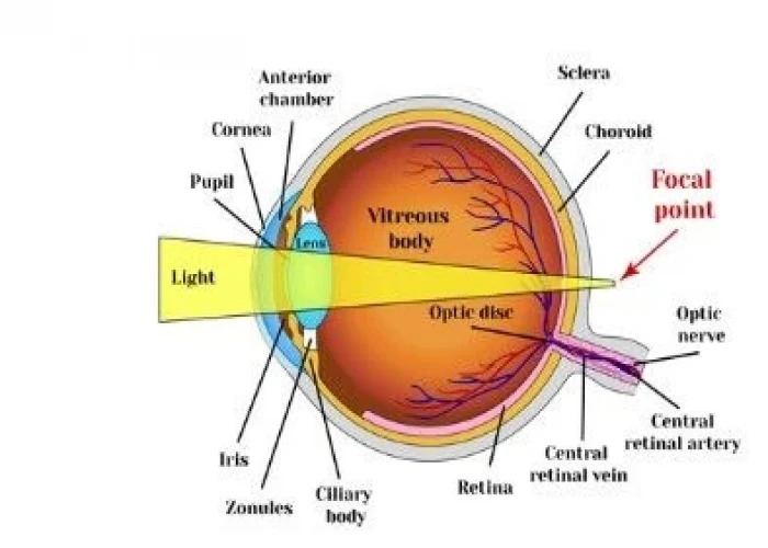 Presbyopia