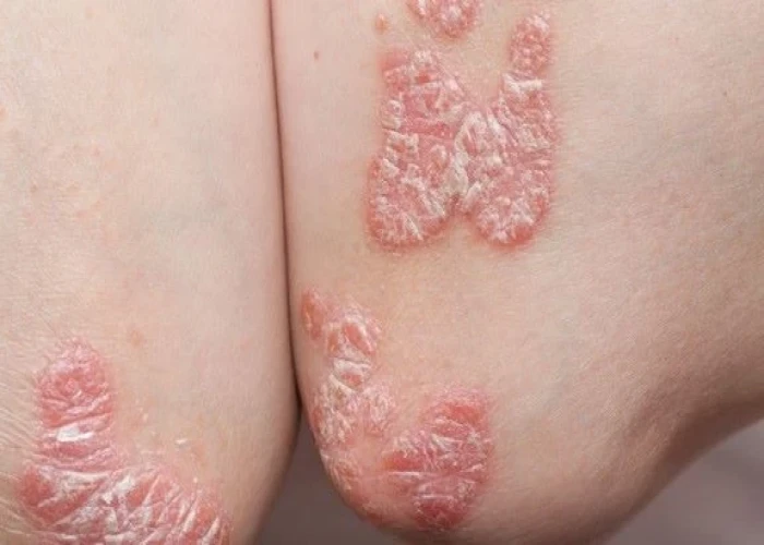 Psoriasis