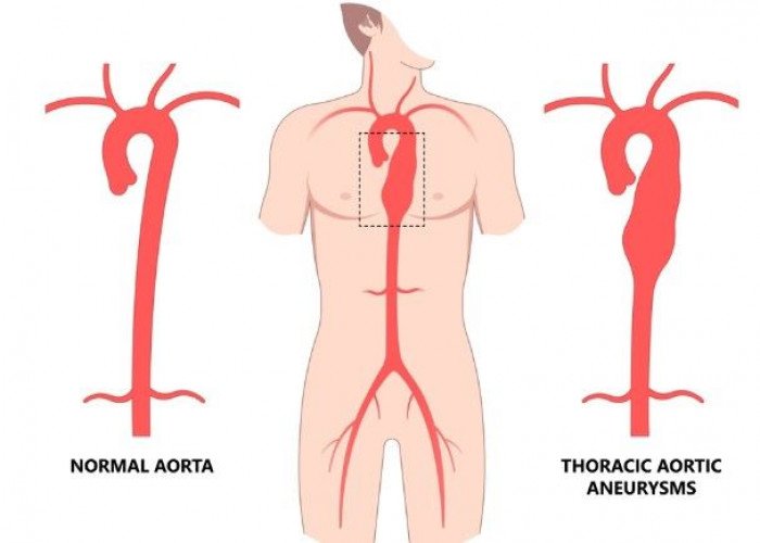 Ehlers-Danlos syndrome