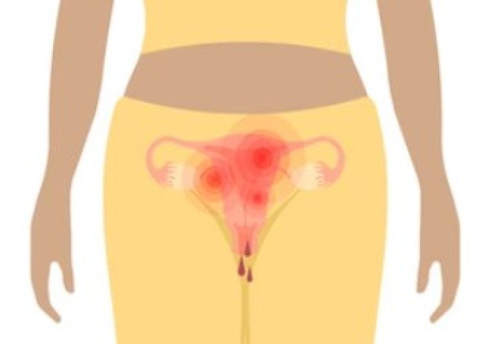 Bleeding from uterus