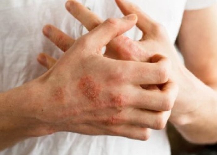 Eczema