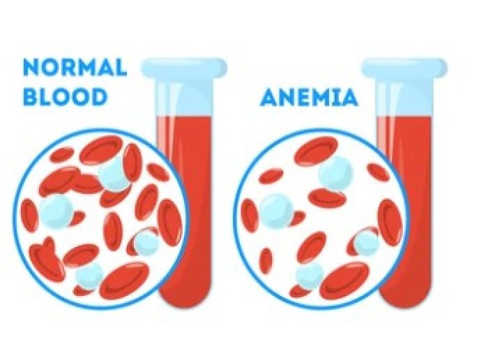 Hemoglobin deficiency